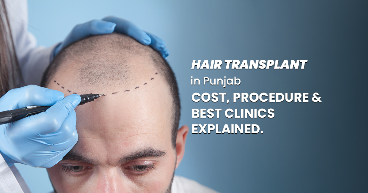 Hair Transplant in Punjab: Cost, Procedure & Best Clinics Explained